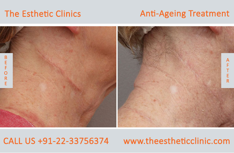 Anti Aging Treatment for Face Wrinkles before after photos in mumbai india (1 (6)